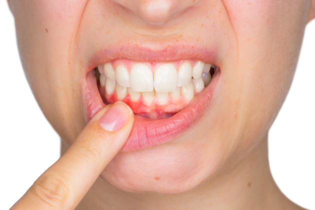 DentaFend Pills Reviews - Solve Your Gum Problems